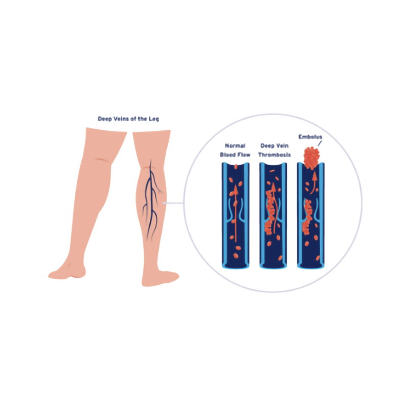 Illustration of deep vein thrombosis (DVT) showing normal blood flow, DVT formation, and embolus development in a leg vein. Illustration of deep vein thrombosis (DVT) showing normal blood flow, DVT formation, and embolus development in a leg vein.